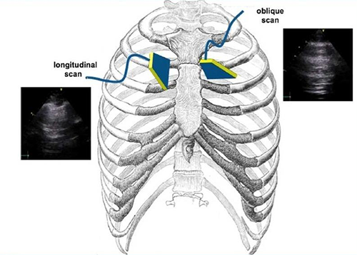 肺部超声在围手术期呼吸道管理中的应用
