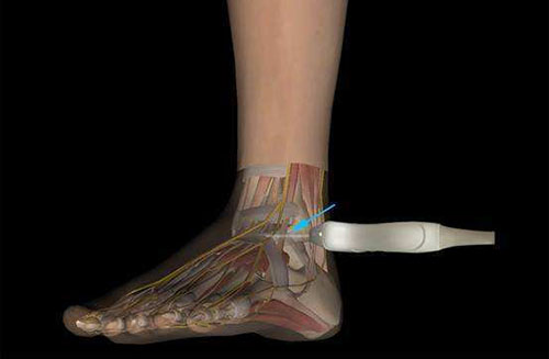 肌骨超声：适用于骨科肌骨检查新方式